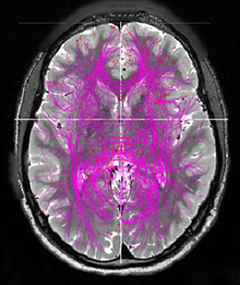 cross-section image of a brain with lines indicating connectivity